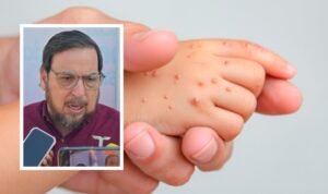 Fortalecen cerco sanitario en escuelas para prevenir el sarampión 2 Fortalecen cerco sanitario en escuelas para